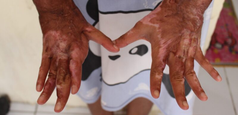 Valeri shows the extent of the burns and scars on her hands and arms
